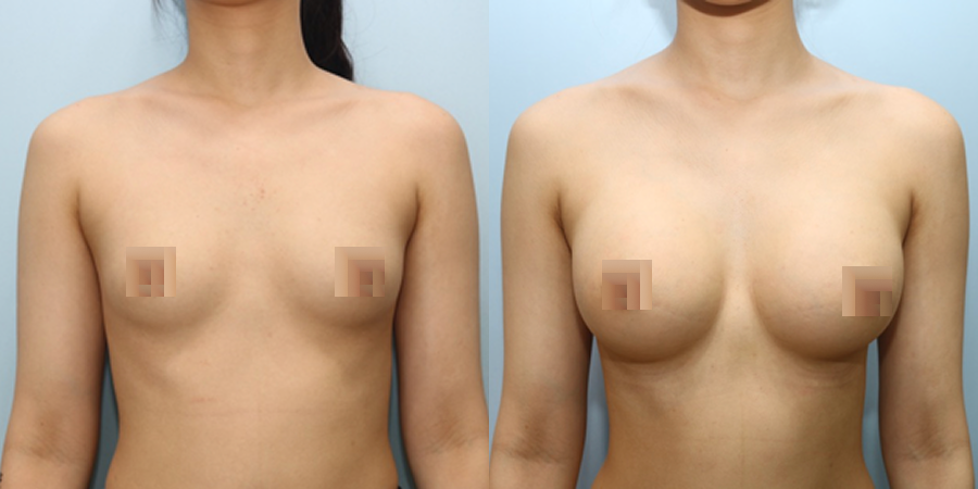 겨드랑이 절개하 첫수술
모티바 보형물 수술 이미지