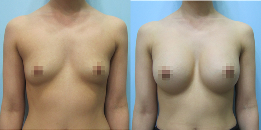 겨드랑이 절개하 첫수술
멘토 보형물 수술 이미지