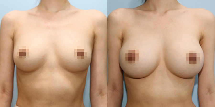 겨드랑이 절개하 첫수술
멘토 보형물 수술 이미지