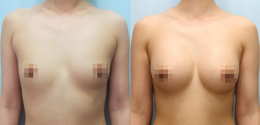 겨드랑이 절개하 첫수술
모티바 보형물 수술 이미지