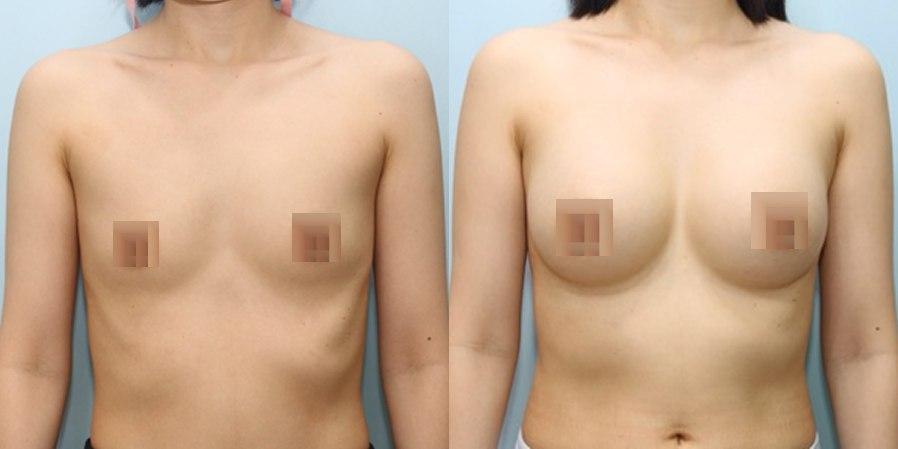 겨드랑이 절개하 첫수술
멘토 보형물 수술 이미지