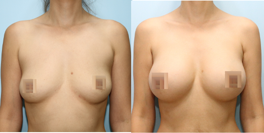 겨드랑이 절개하 첫수술
멘토 보형물 수술 이미지