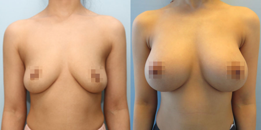 겨드랑이 절개하 첫수술
멘토 보형물 수술 이미지