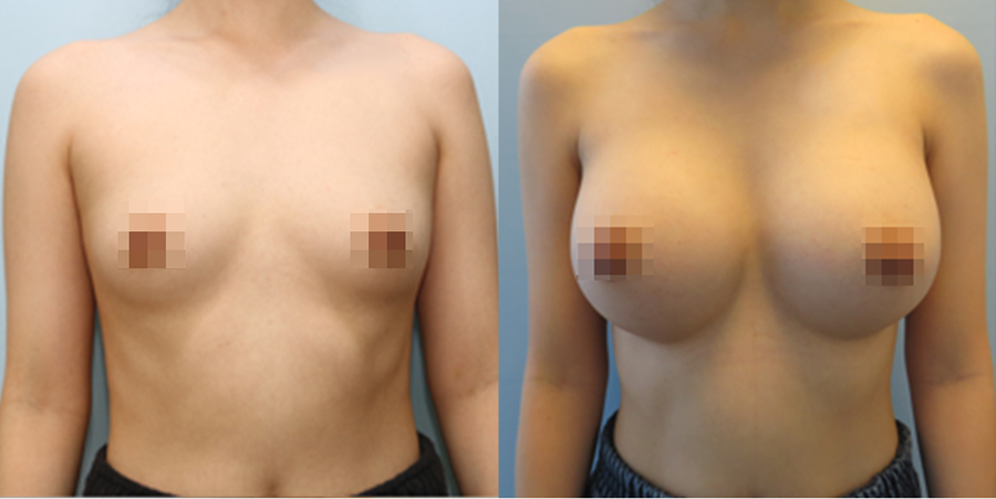 겨드랑이 절개하 첫수술
모티바 보형물 수술 이미지