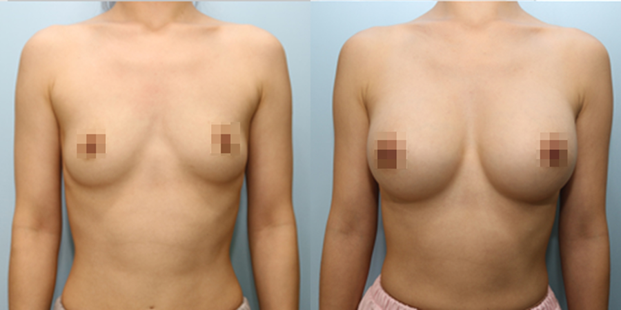 겨드랑이 절개하 첫수술
모티바 보형물 수술 이미지