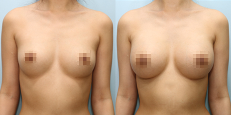 겨드랑이 절개하 첫수술
모티바 보형물 수술 이미지