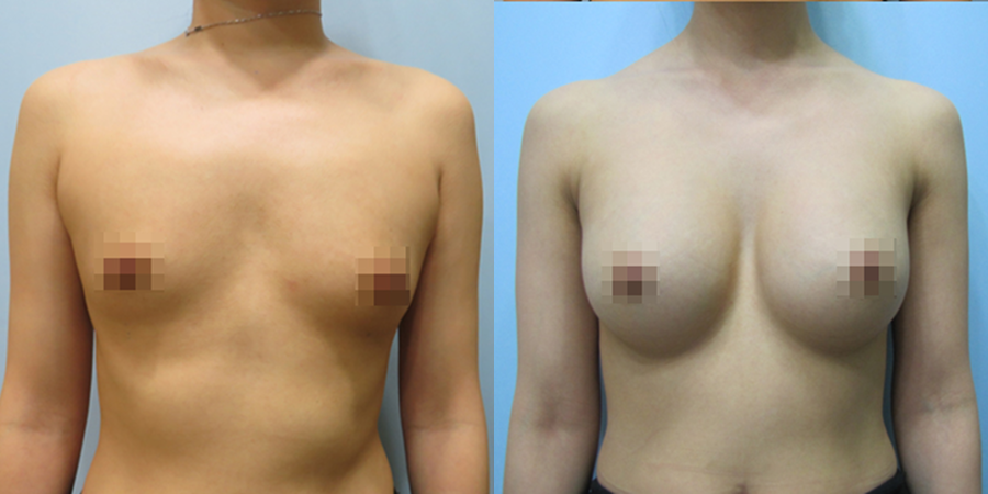 겨드랑이 절개하 첫수술
멘토 보형물 수술 이미지