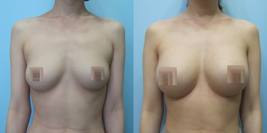 겨드랑이 절개하 첫수술
모티바 보형물 수술 이미지