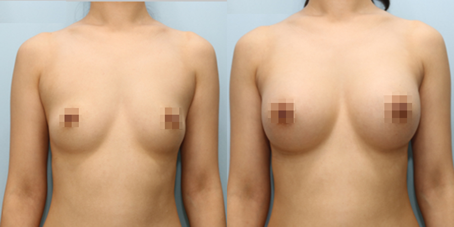 겨드랑이 절개하 첫수술
모티바 보형물 수술 이미지