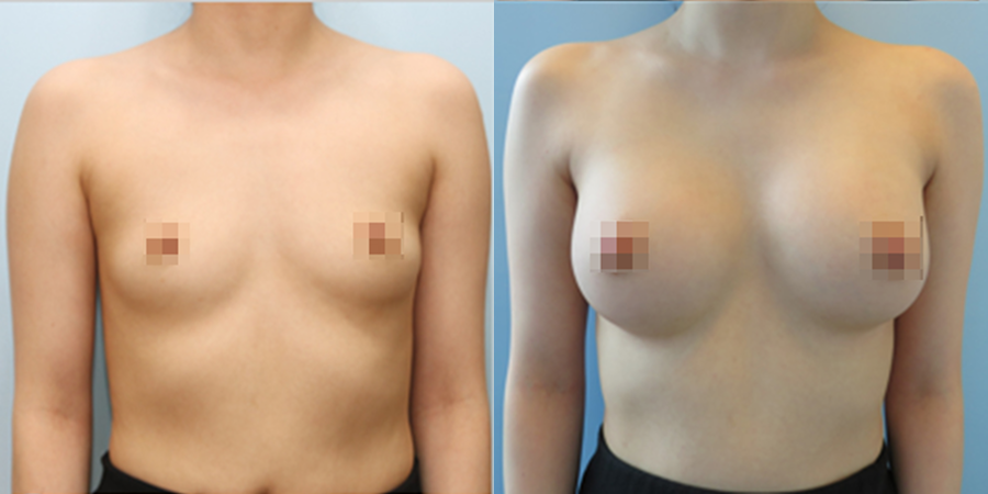 겨드랑이 절개하 첫수술
모티바 보형물 수술 이미지