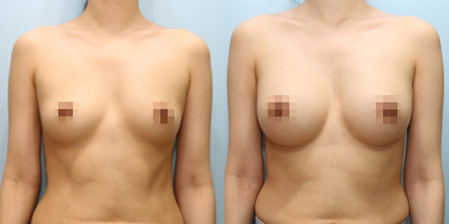 겨드랑이 절개하 첫수술
세빈 보형물 수술 이미지