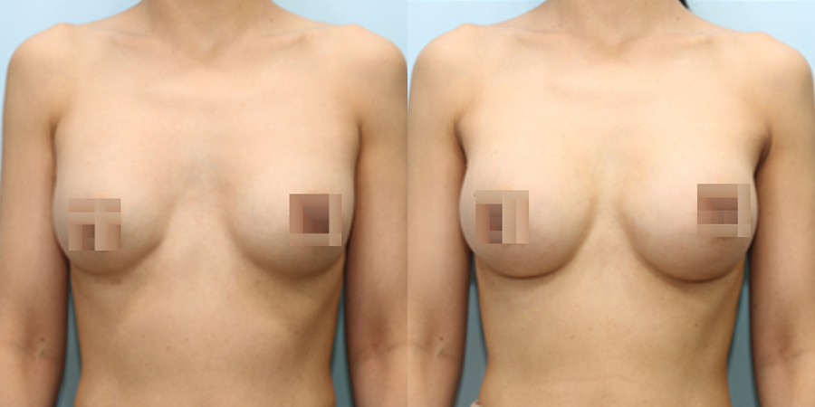 겨드랑이 절개하 재수술
모티바 보형물 수술 이미지