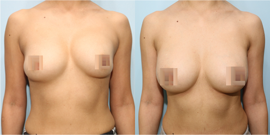 겨드랑이 절개하 재수술
모티바 보형물 수술 이미지