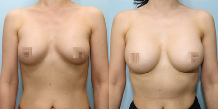 겨드랑이 절개하 재수술
모티바 보형물 수술 이미지