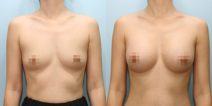 겨드랑이 절개하 재수술
멘토 보형물 수술 이미지