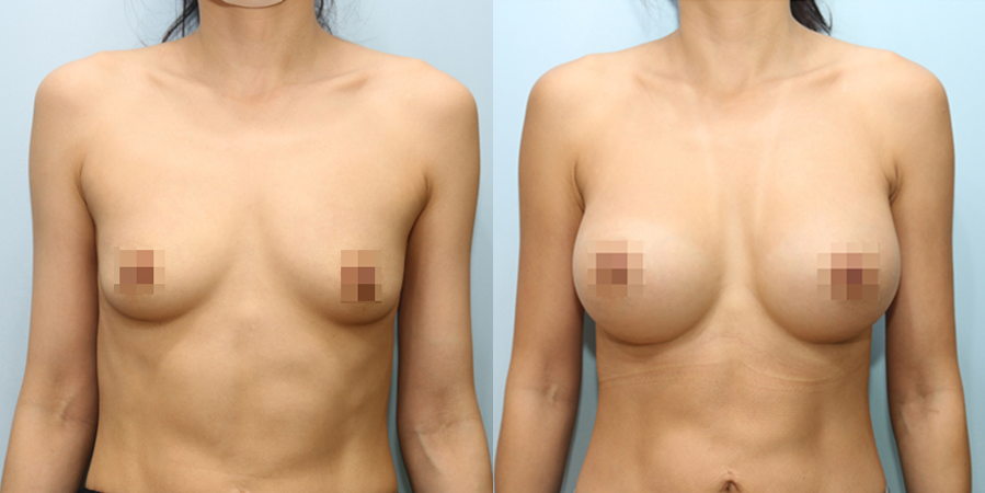 겨드랑이 절개하 재수술
모티바 보형물 수술 이미지